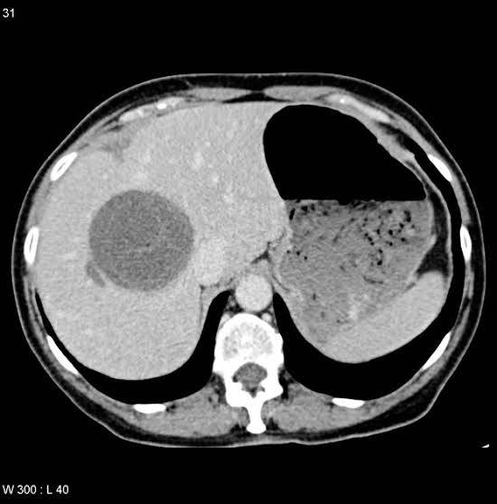 CT-Liver