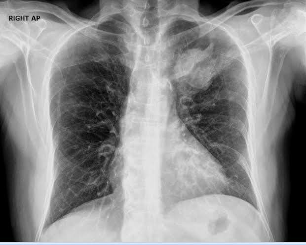 Chest-x-ray