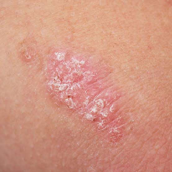 Dermatology