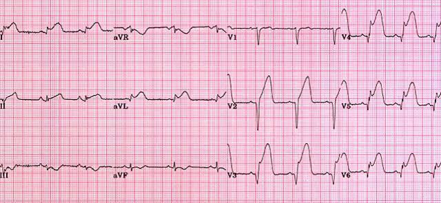 ECG