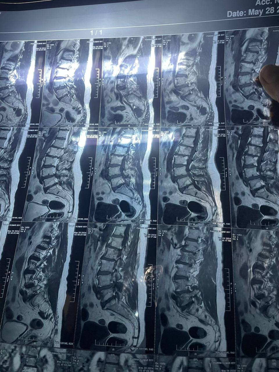 Spine-MRI