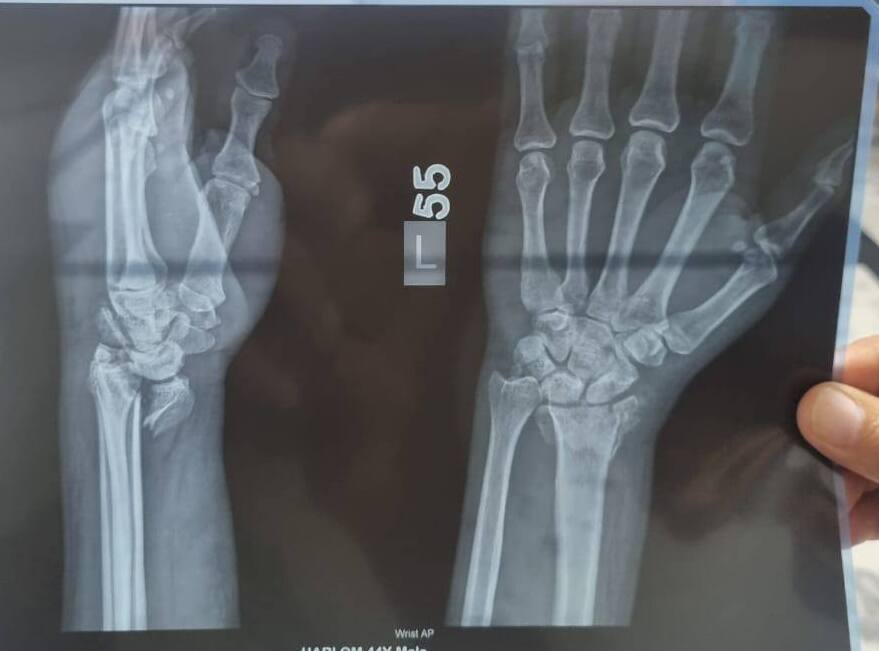X-Ray
